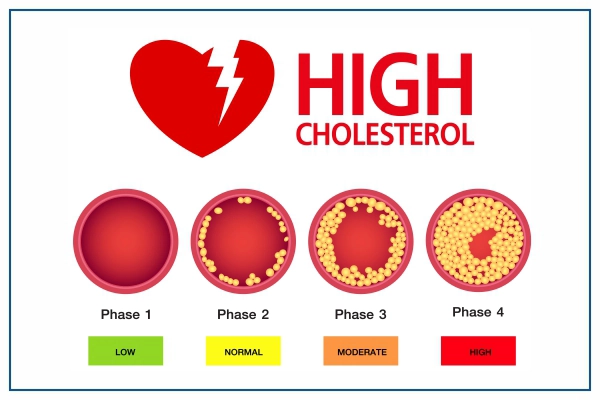 Understanding Cholesterol: A Comprehensive Guide to Diet and Health